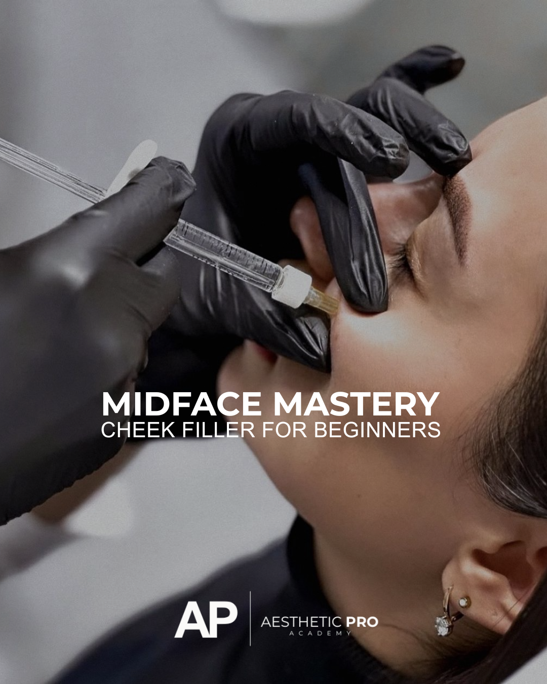 Cheek filler for new injectors.