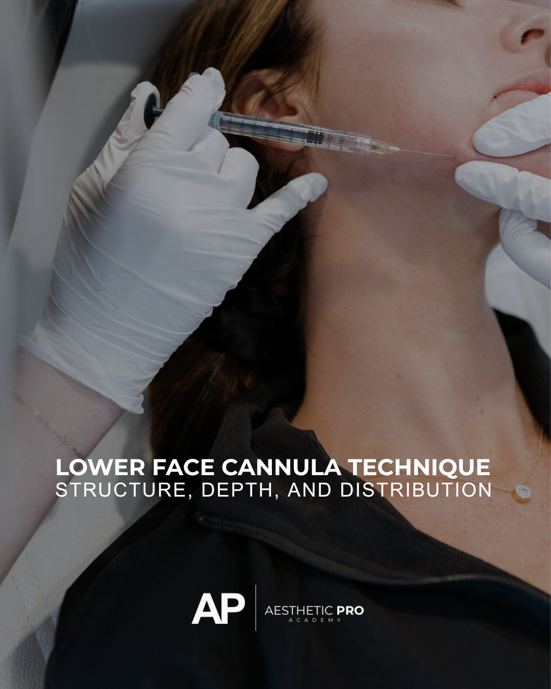 Cannula technique in the lower face.