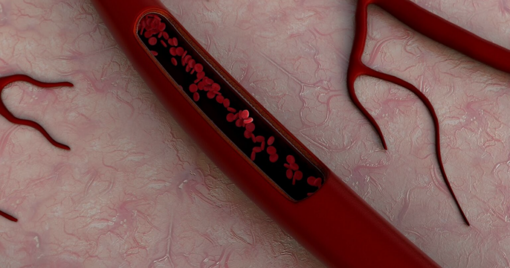 Vascular occlusion recognition and prevention in aesthetic injecting.