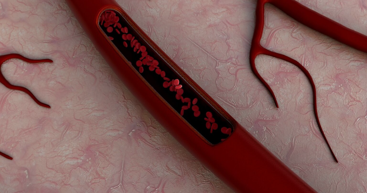 Vascular occlusion recognition and prevention in aesthetic injecting.